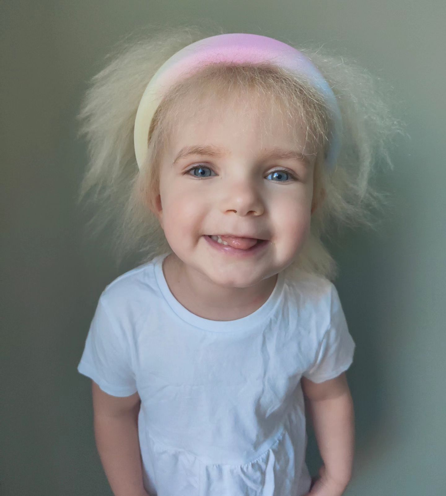 У трирічної дівчинки з Великої Британії діагностували синдром нерозчесаного волосся: таких людей лише 100 на весь світ. Фото
