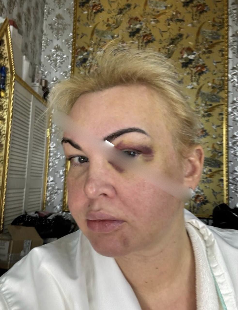 Сеть шокировали фото Камалии в синяках и крови: певица отреагировала