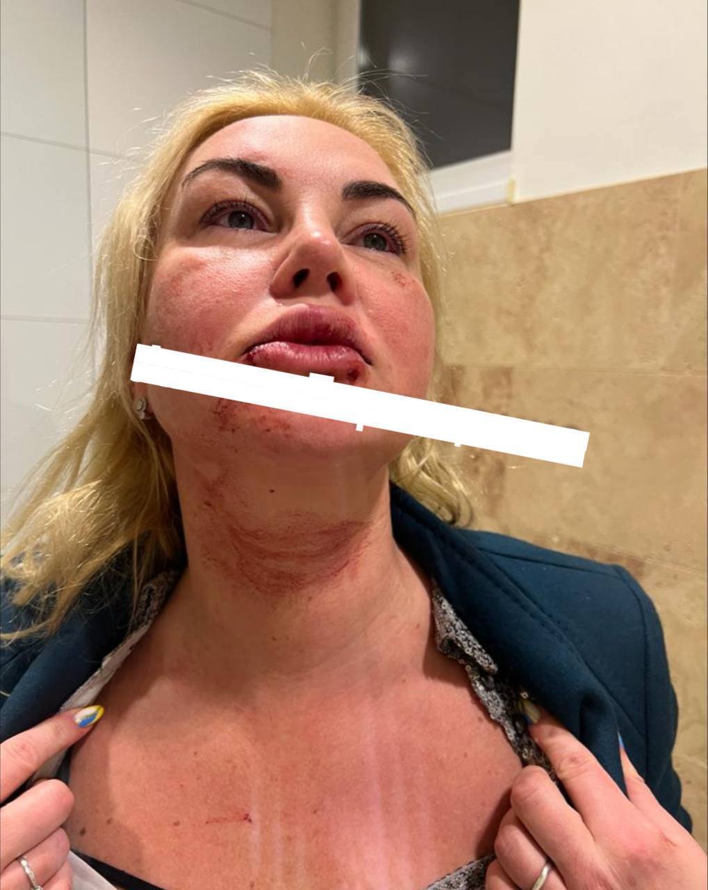 Сеть шокировали фото Камалии в синяках и крови: певица отреагировала