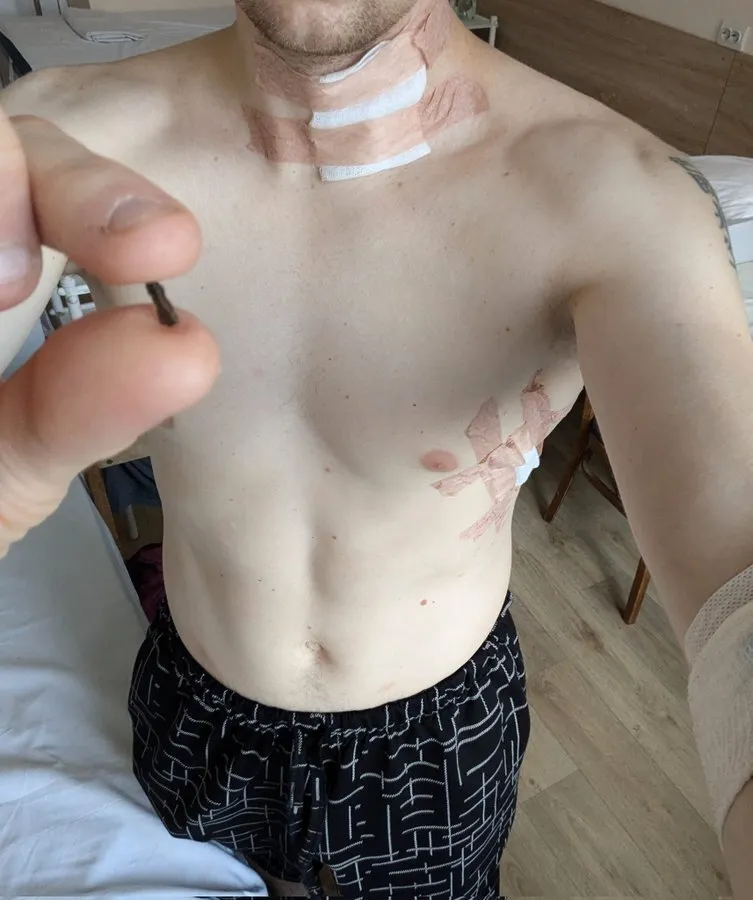 "Обломок вошел в шею": бывший политзаключенный Кремля Станислав Асеев получил ранение на фронте. Фото