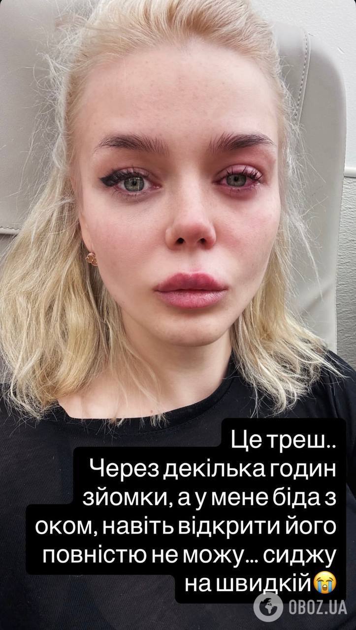 Аліні Гросу викликали швидку на зйомках через "біду" з обличчям: артистка назвала діагноз і не стримала сліз