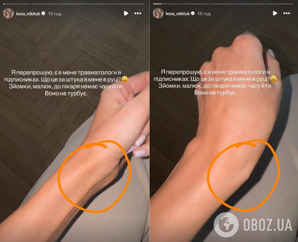 Леся Нікітюк переполошилася через пухлину на руці та пояснила, чому не може піти до лікаря: підписники допомогли їй з діагнозом