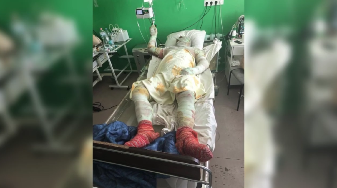 Получил 70% ожогов и заново учился ходить: сеть тронула история украинского пограничника. Видео