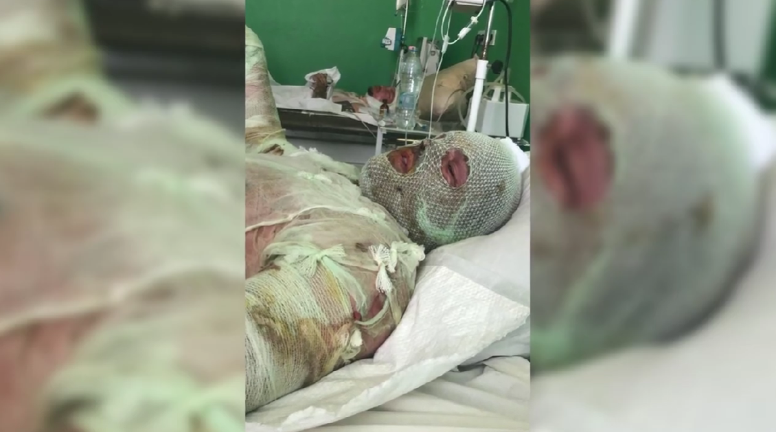 Получил 70% ожогов и заново учился ходить: сеть тронула история украинского пограничника. Видео