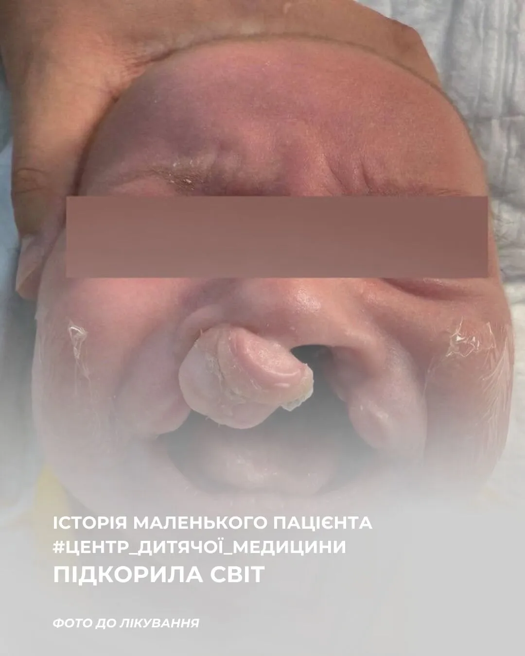 Найкращий клінічний кейс у світі: малюку з Івано-Франківська зробили надскладну пластичну операцію. Фото