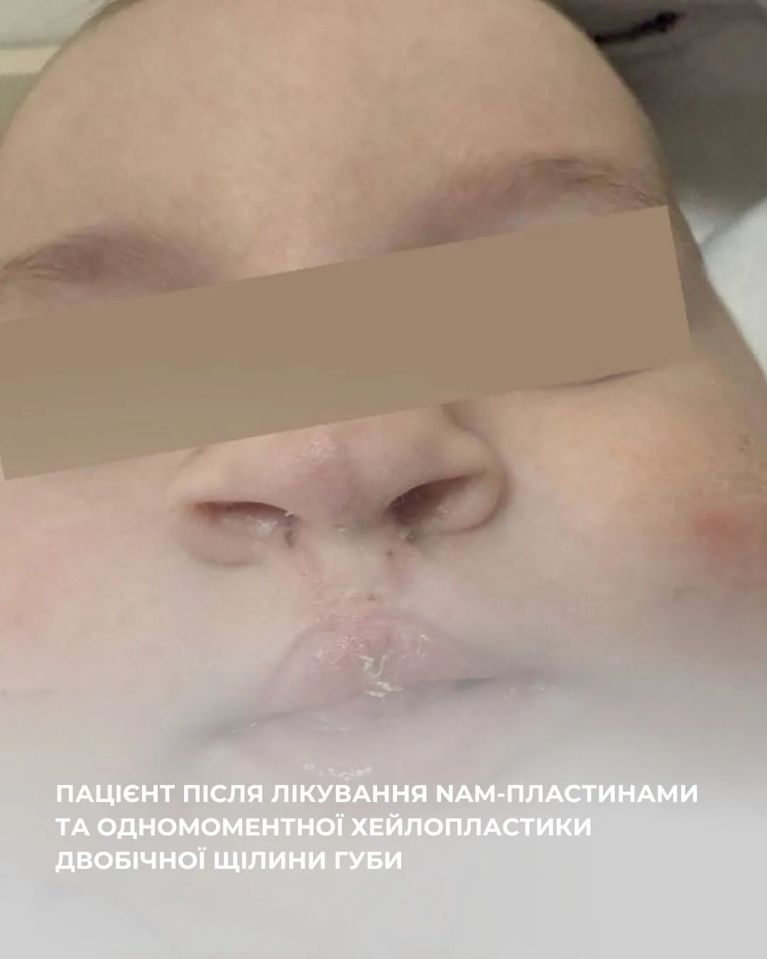 Найкращий клінічний кейс у світі: малюку з Івано-Франківська зробили надскладну пластичну операцію. Фото