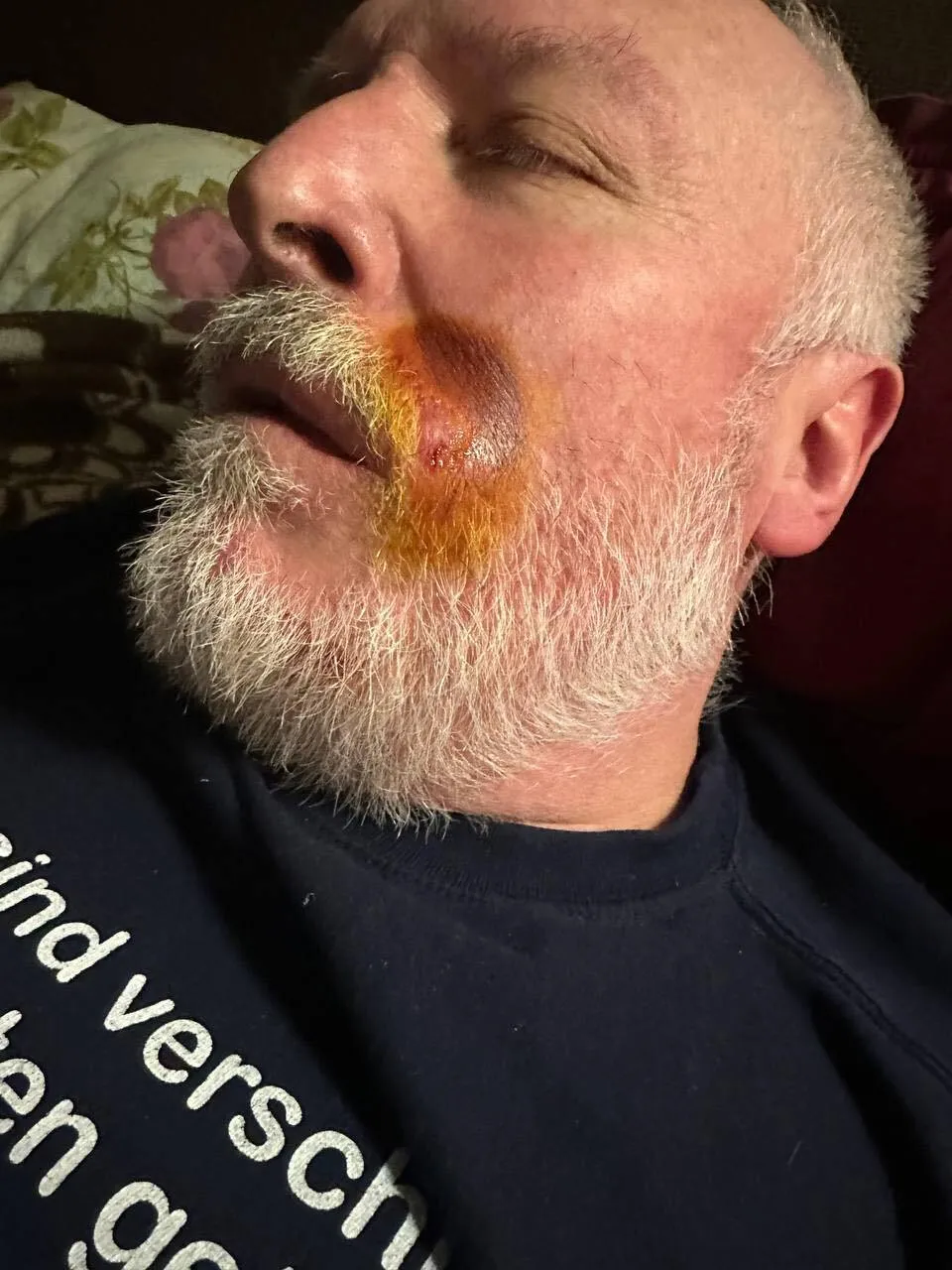 В Киеве отцу известного блогера Степанца курьер Glovo разбил лицо кастетом. Все подробности