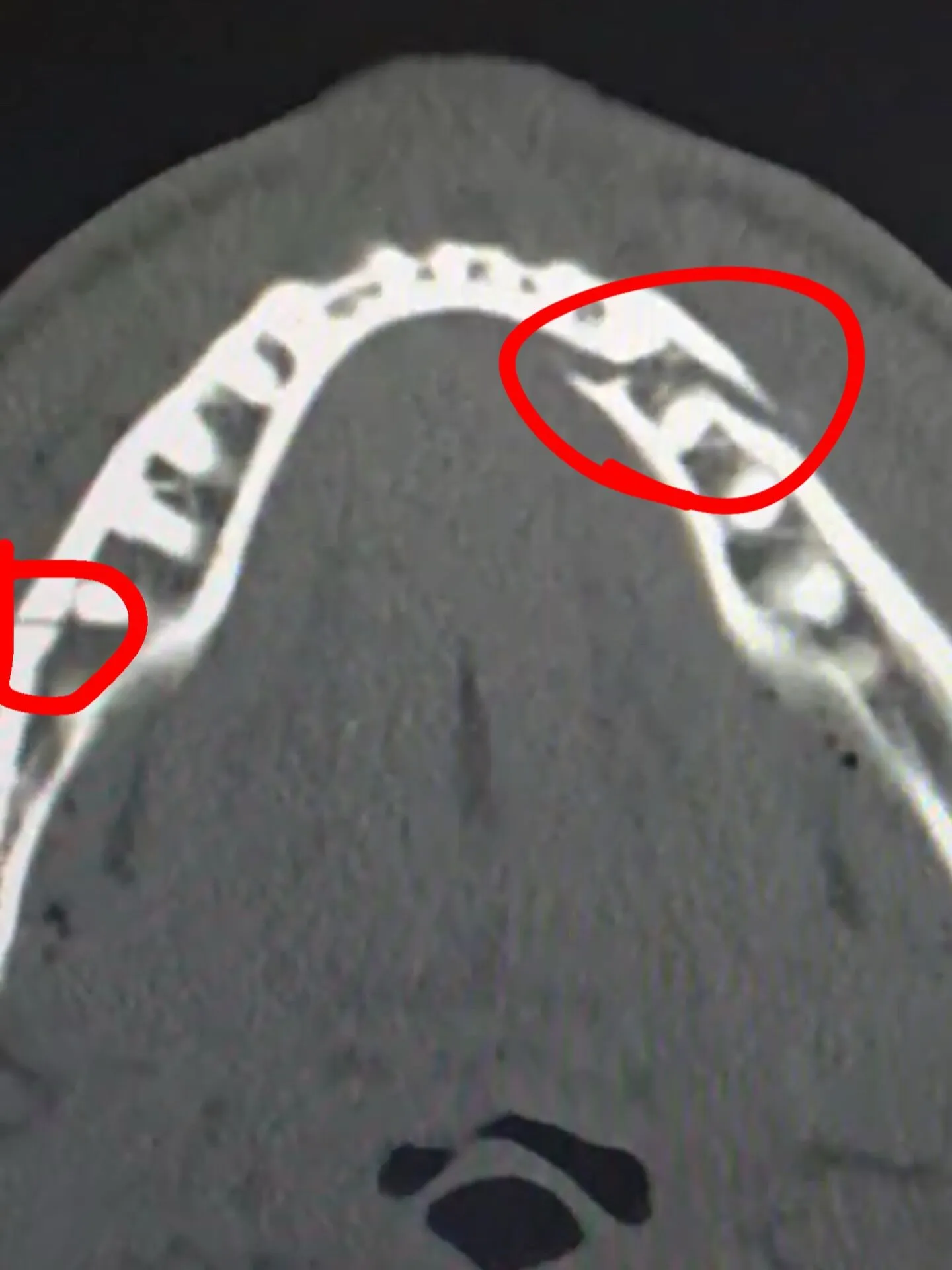 Три нокдауна и перелом челюсти! Бой Пол – Джошуа завершился нокаутом в шестом раунде. Видео