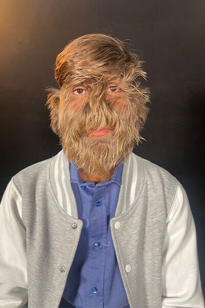 Обличчя на 95% вкрите волоссям: унікальний підліток із синдромом перевертня потрапив у Книгу рекордів Гіннеса. Фото 