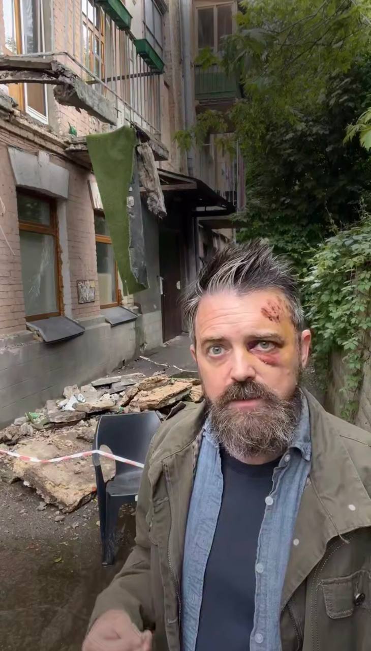 У Києві обвалився балкон із американським режисером: Кріс Волтерс показав свої травми та пригрозив розслідуванням. Відео