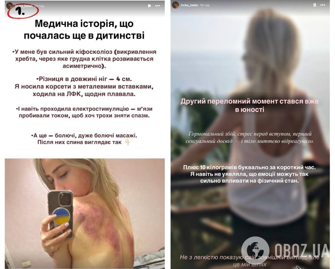 Колишня дівчина "Терена" Інна Бєлєнь зробила дві пластичні операції та розповіла, що змінила в собі. Фото