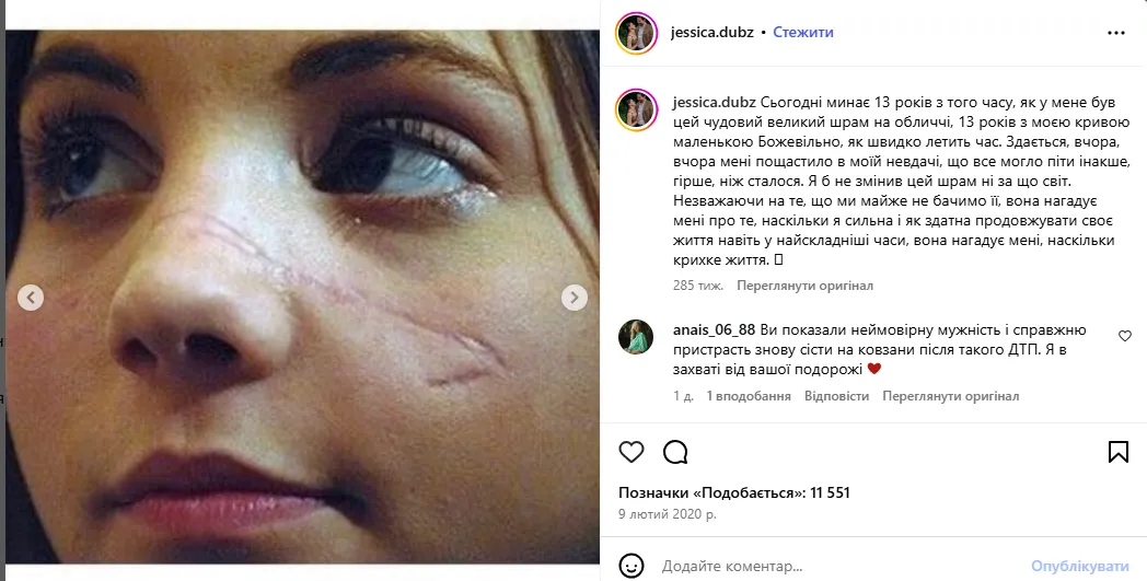 Один із найтрагічніших інцидентів в історії фігурного катання зібрав 5,6 млн переглядів за кілька годин. Відео