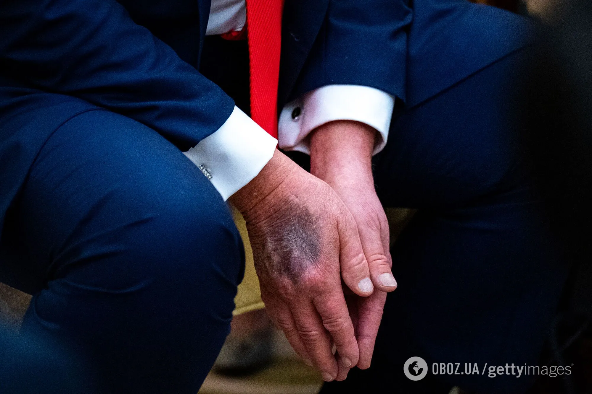 У Трампа знову помітили синець на руці: що відомо про хворобу президента США. Фото