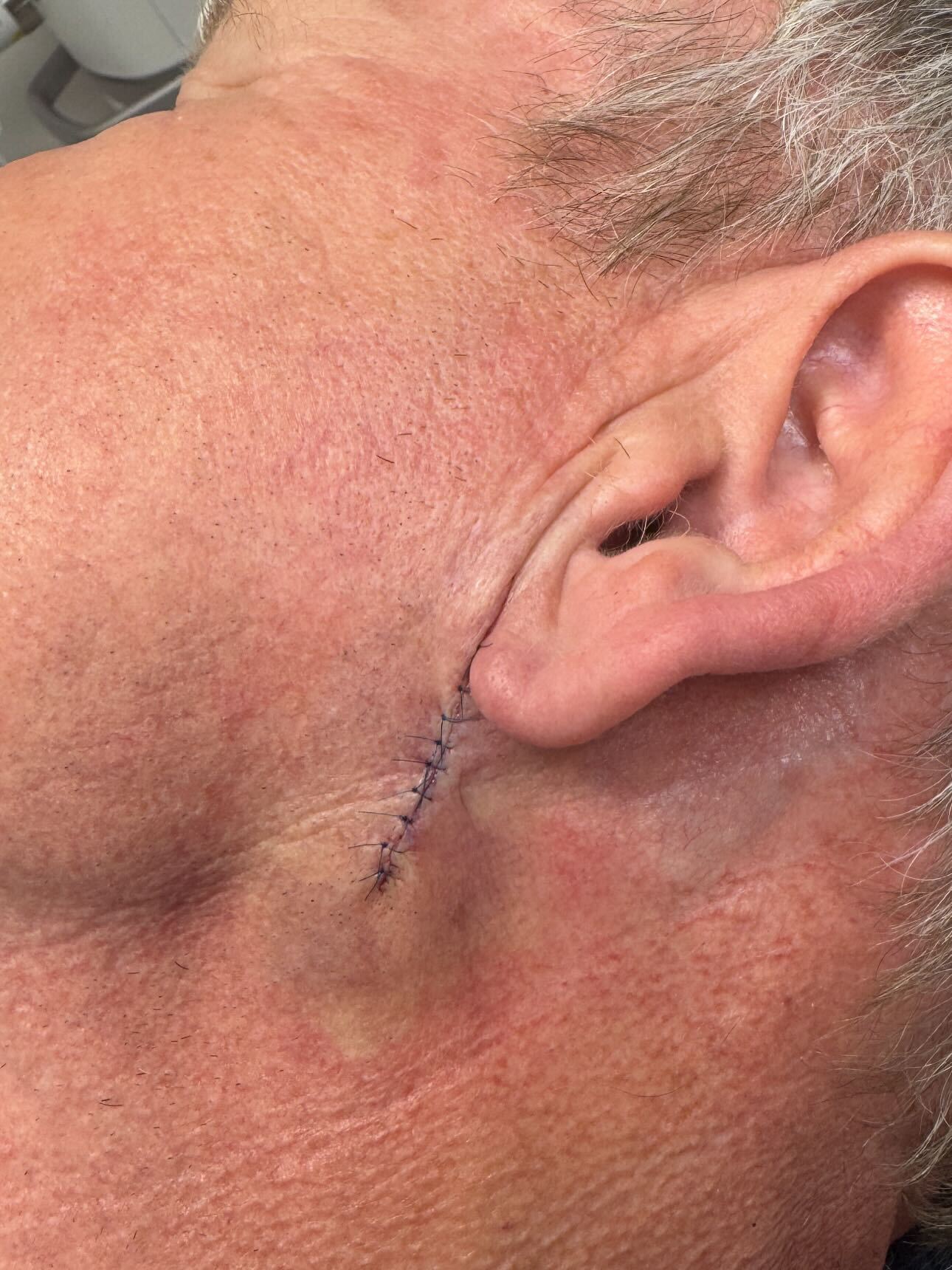 Шеф-повар Гордон Рамзи впервые рассказал о своей борьбе с раком и показал фото после удаления опухоли