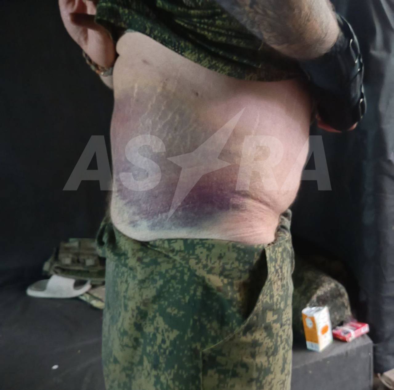 "Повезли обнуляти": Росія відправила своїх солдатів на милицях, у гіпсі та з пластиною в голові у штурм на Сіверському напрямку. Відео