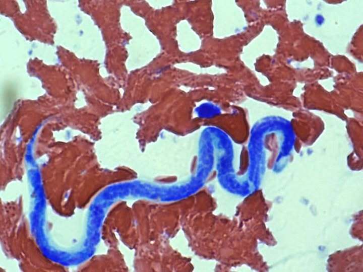 Во Львове врачи удалили из глаза мужчины 12-сантиметрового гельминта: заразился из-за укуса комара на отдыхе. Фото