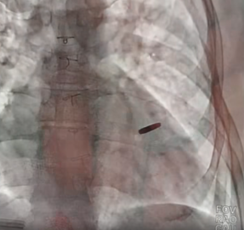 Захисник "Азовсталі" провів три роки в полоні РФ з кулею в серці: після звільнення йому зробили операцію. Відео