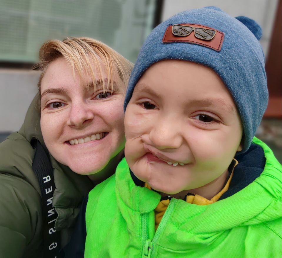 Було накладено 500 швів, дитина росте в лікарнях: як склалась доля хлопчика, який постраждав від вибуху на виставці в Чернігові у 2022 році. Фото