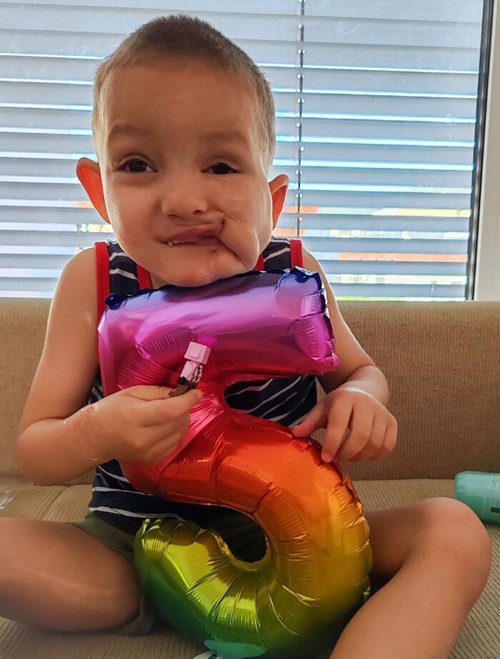 Було накладено 500 швів, дитина росте в лікарнях: як склалась доля хлопчика, який постраждав від вибуху на виставці в Чернігові у 2022 році. Фото