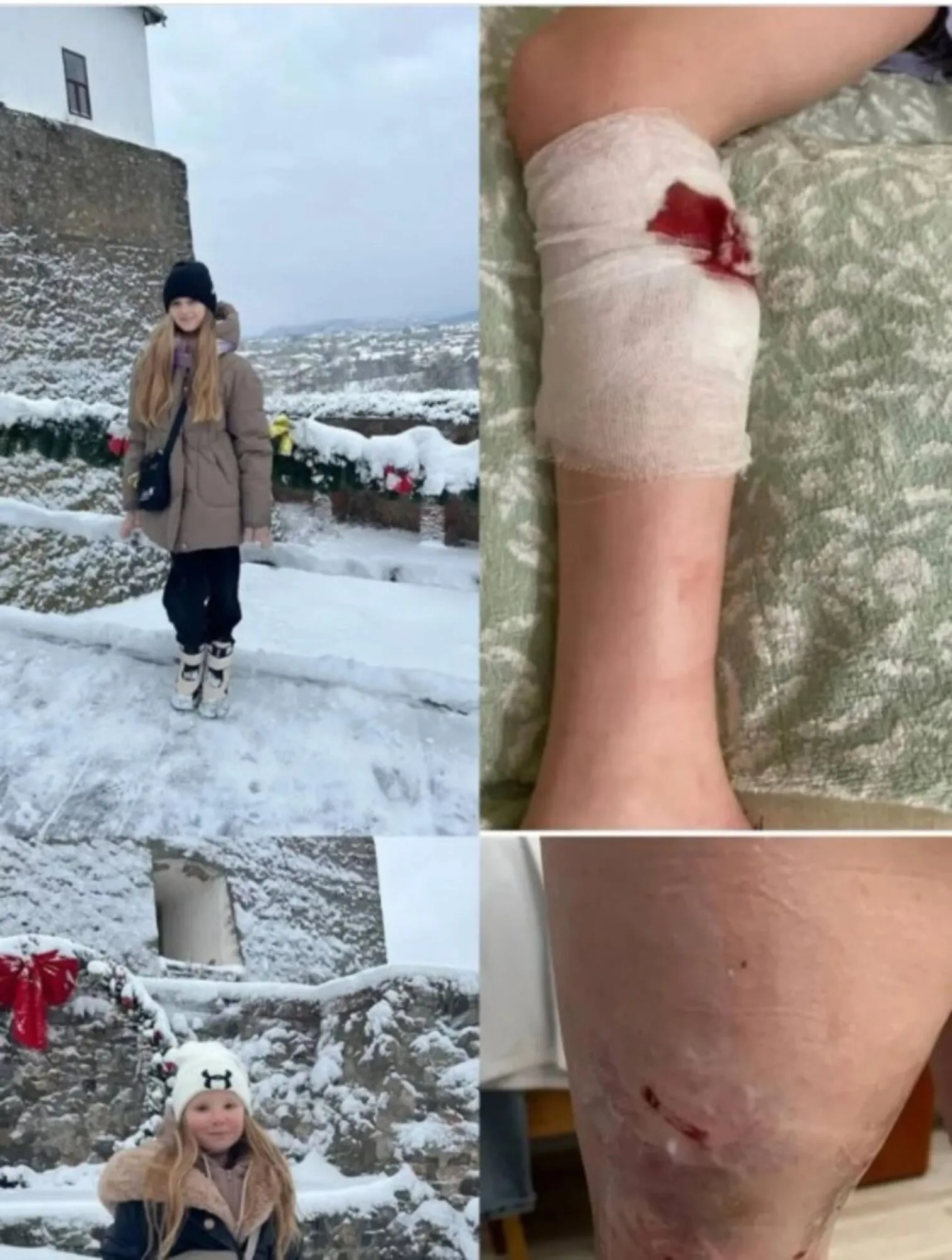 Зашивали рвані рани на нозі: на Закарпатті власник кафе нацькував на дітей собак