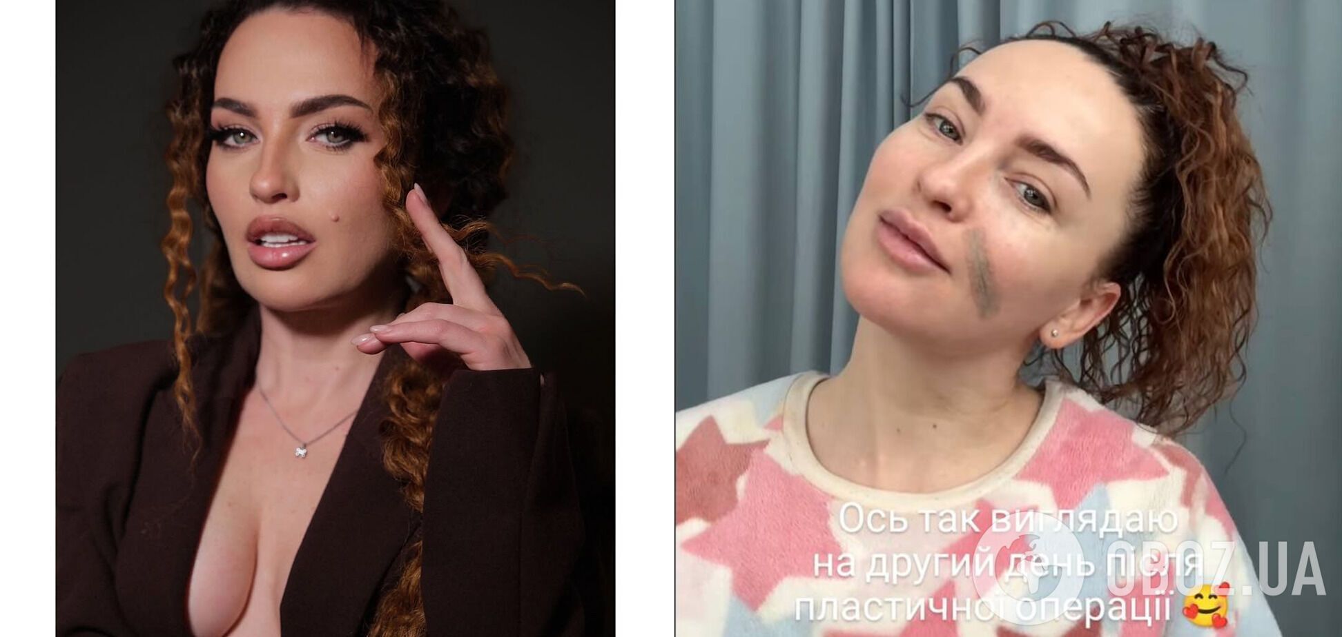 Звезда "Дизель шоу" сделала пластическую операцию на лице. Фото до и после