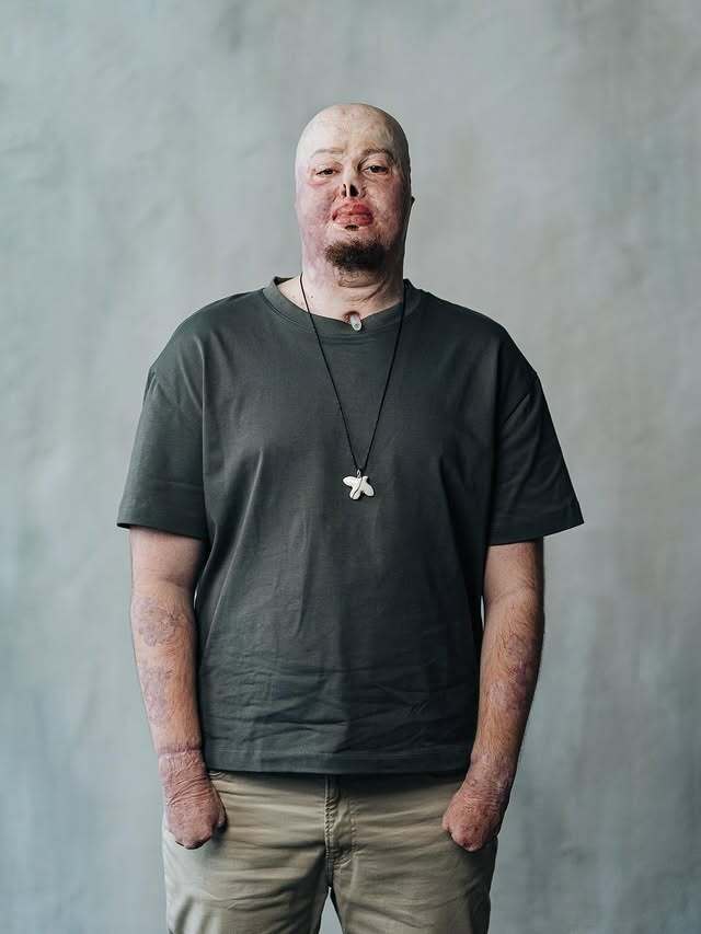 "Мені подобається все в моєму житті". Незламний ветеран, який отримав важкі опіки, знайшов кохання в інтернеті. Фото пари