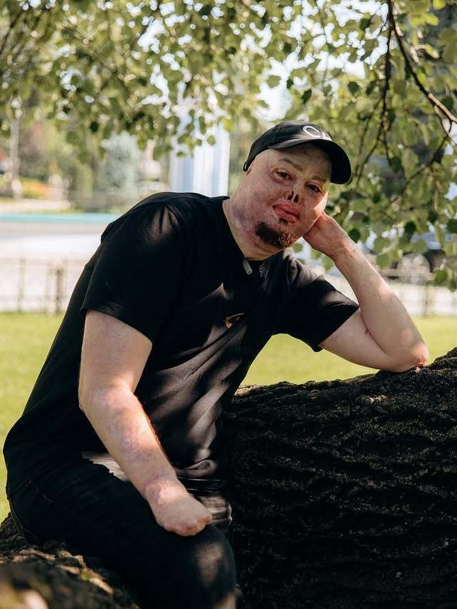 "Мені подобається все в моєму житті". Незламний ветеран, який отримав важкі опіки, знайшов кохання в інтернеті. Фото пари