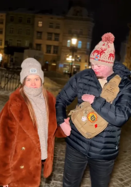 "Мені подобається все в моєму житті". Незламний ветеран, який отримав важкі опіки, знайшов кохання в інтернеті. Фото пари