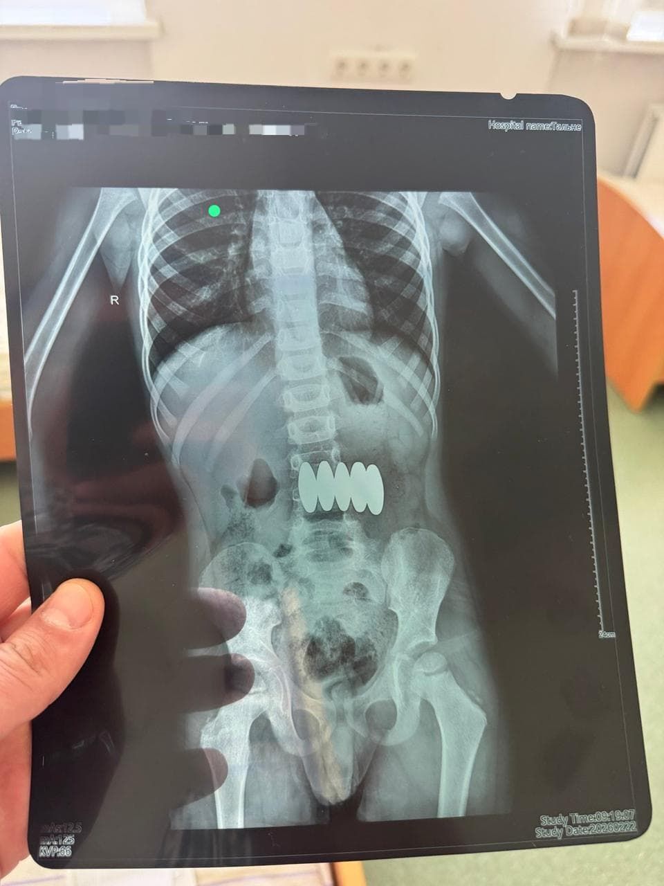 "Небезпечна іграшка": у Черкасах медики врятували дитину, яка проковтнула п'ять магнітів. Фото