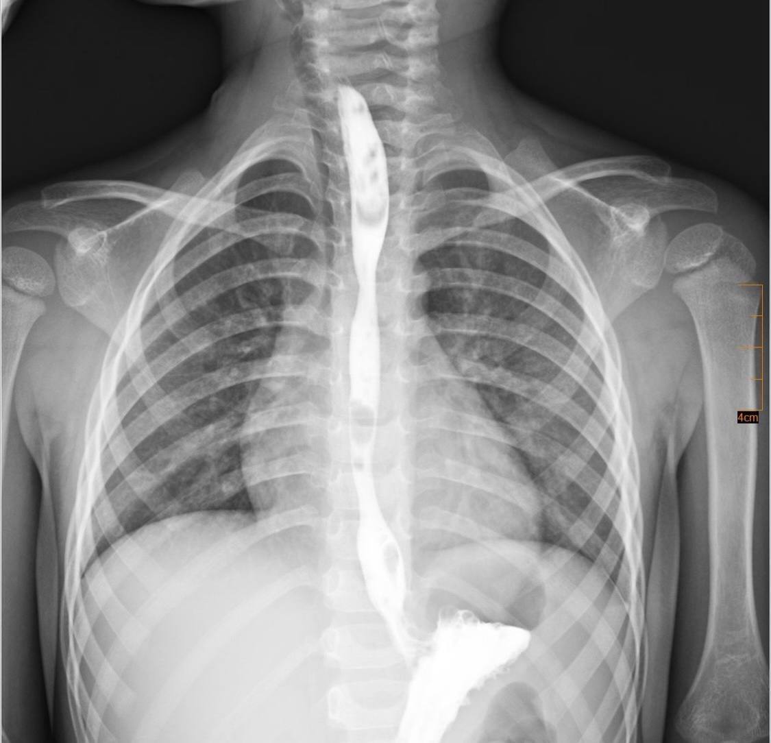 Лікування тривало два роки: у Львові врятували трирічну дитину, яка випила засіб для видалення жиру