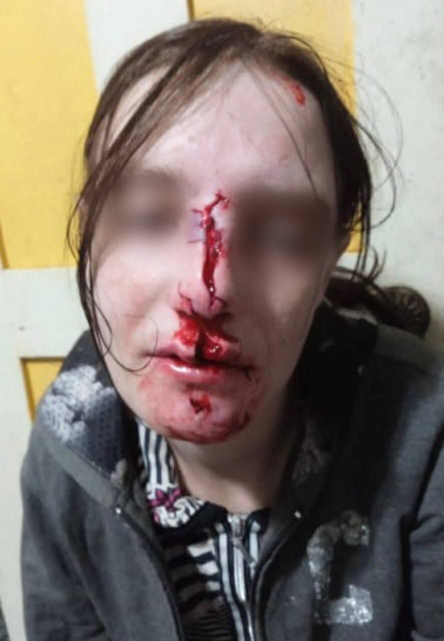 У Кривому Розі вівчарка розірвала обличчя дівчині під час стриму у ТікТок: деталі трагедії