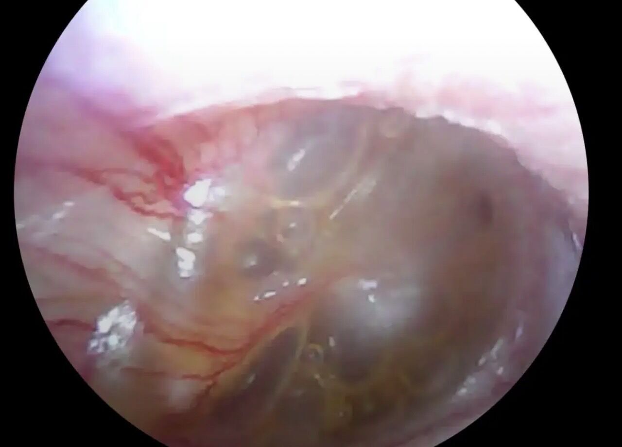 Скаржилася на біль: в Івано-Франківську у вусі пацієнтки лікарі виявили павука. Фото і відео