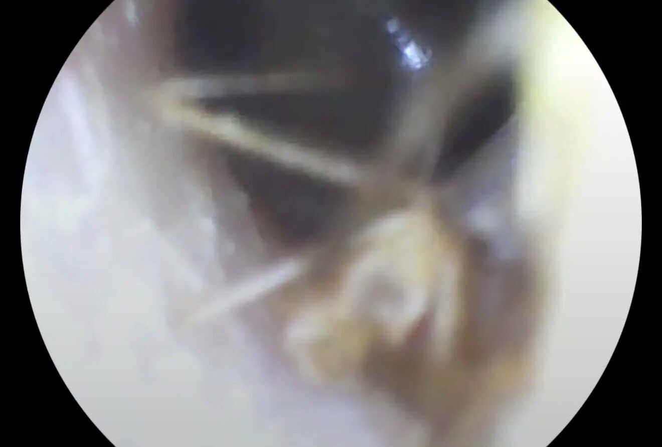 Скаржилася на біль: в Івано-Франківську у вусі пацієнтки лікарі виявили павука. Фото і відео