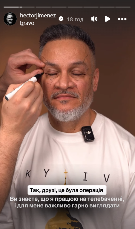 Ектор Хіменес-Браво зробив пластичну операцію та показав, який вигляд має його обличчя тепер. Фото
