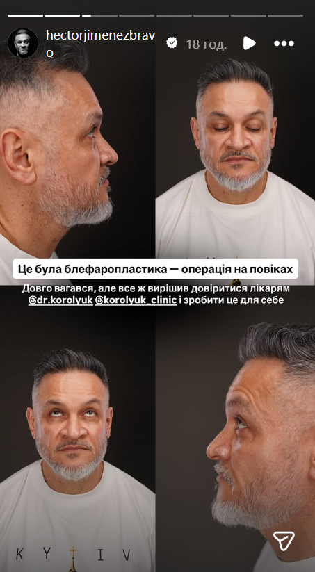 Ектор Хіменес-Браво зробив пластичну операцію та показав, який вигляд має його обличчя тепер. Фото