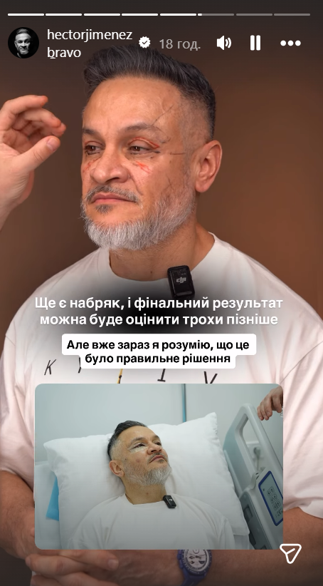 Ектор Хіменес-Браво зробив пластичну операцію та показав, який вигляд має його обличчя тепер. Фото