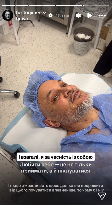 Ектор Хіменес-Браво зробив пластичну операцію та показав, який вигляд має його обличчя тепер. Фото