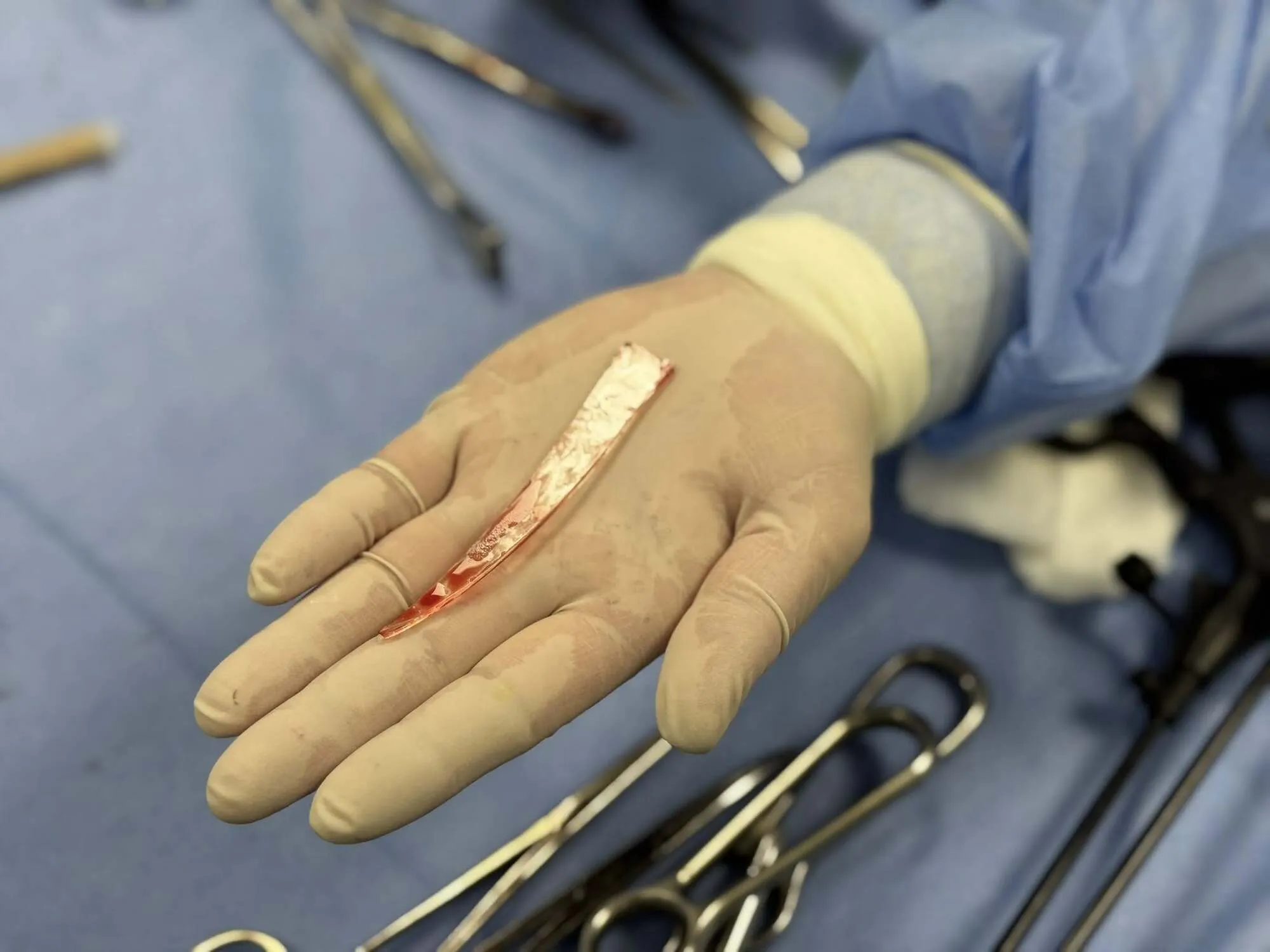 Во Львове спасли мужчину, у которого в легких застрял 10-сантиметровый кусок стекла после атаки РФ. Фото