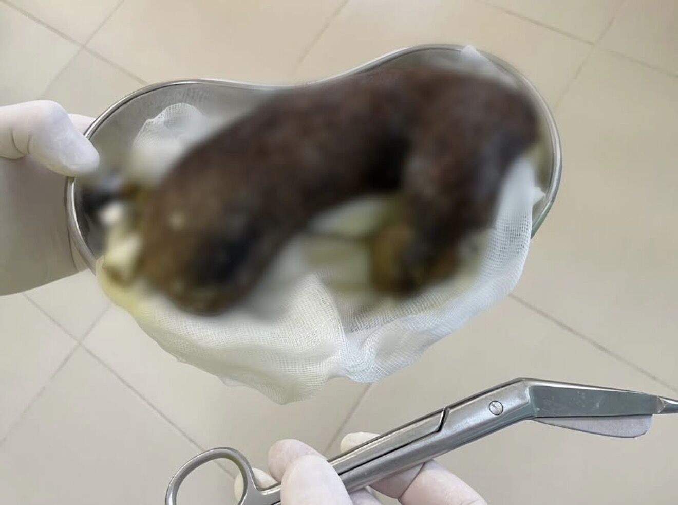 "Синдром Рапунцель": во Львове спасли 13-летнюю девочку с 35-сантиметровым клубком волос в желудке. Фото