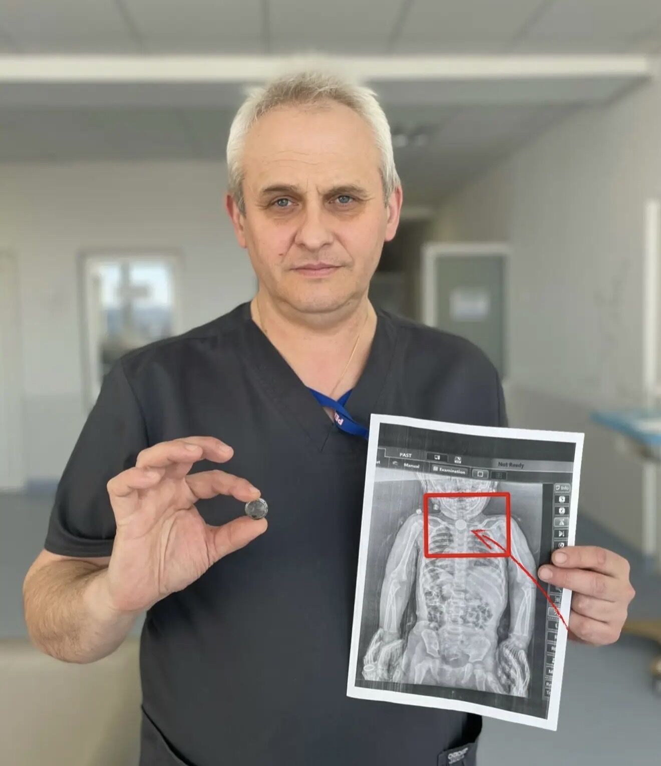 Мучилася від болю: у Львові медики врятували дворічну дівчинку, яка три місяці жила з літієвою батарейкою у стравоході. Фото