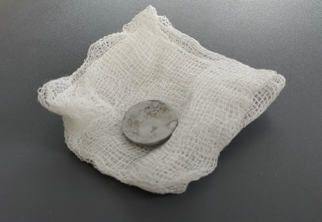 Мучилася від болю: у Львові медики врятували дворічну дівчинку, яка три місяці жила з літієвою батарейкою у стравоході. Фото