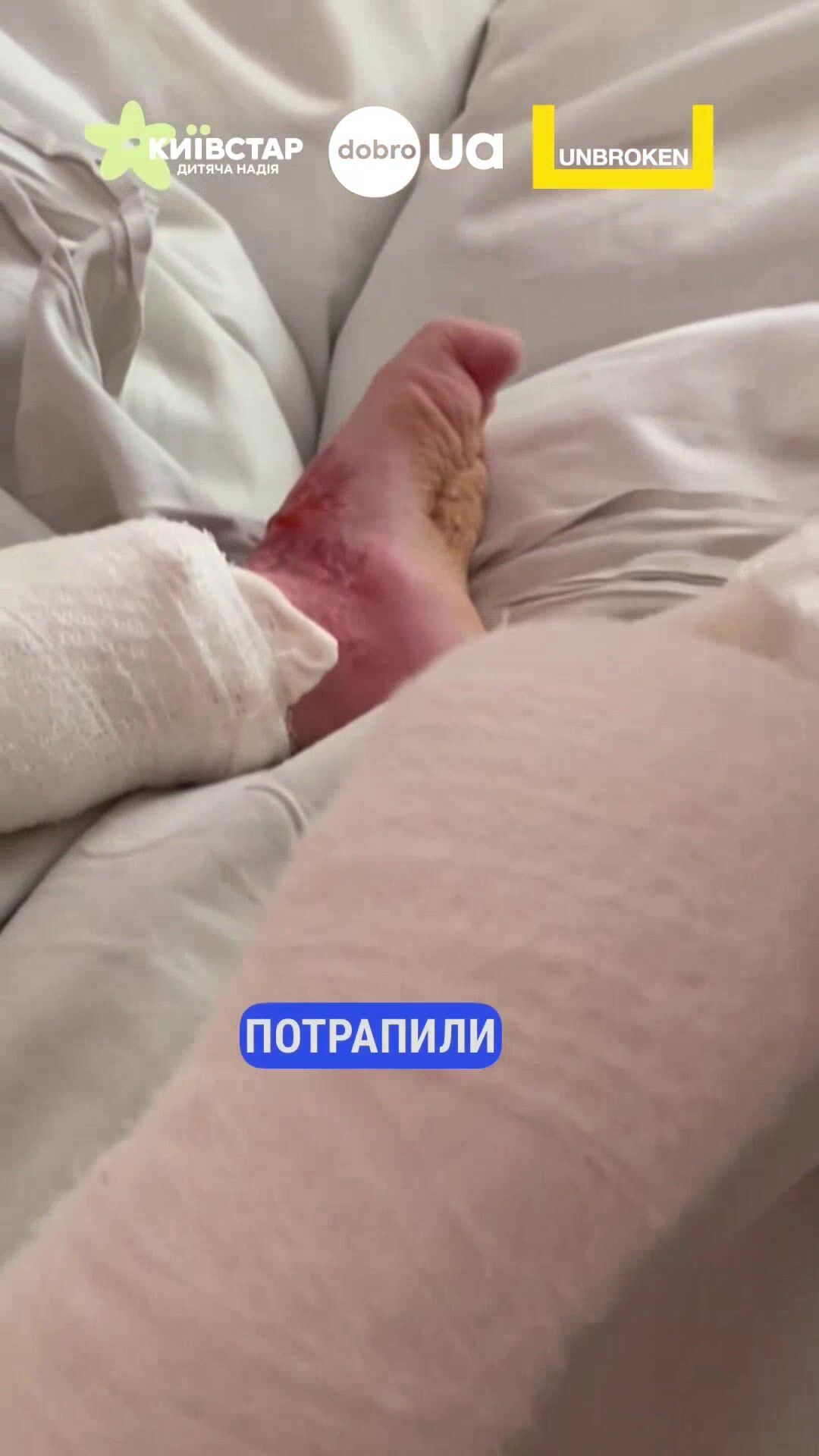 "Шансів майже не було": у Львові врятували 3-річного хлопчика із опіками 70% площі тіла. Відео
