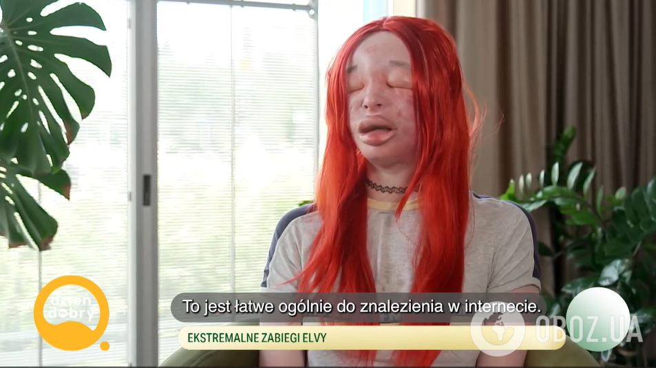26-летняя трансженщина из Польши годами сама себе колола силикон: что произошло с ее лицом. Жуткие фото
