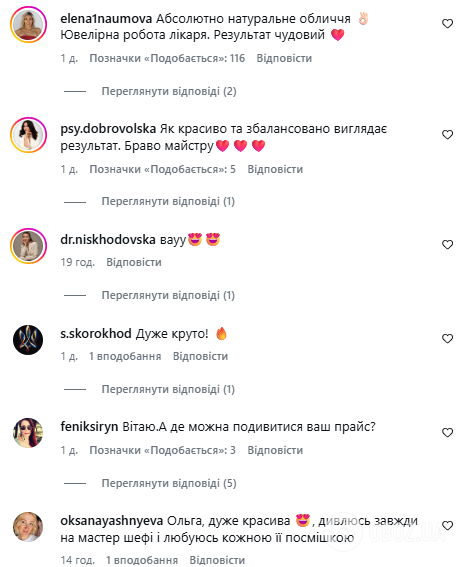 Підтяжка і збільшення губ: зірка "МастерШеф" Мартиновська ошелешила результатом "ювелірної" роботи косметологів: яким було її обличчя до