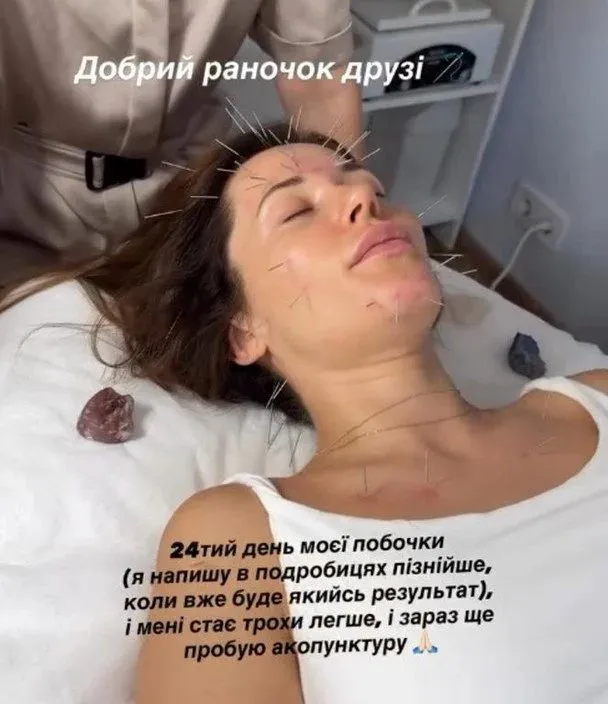 Зірка вирішила спробувати акупунктуру, аби покращити самопочуття