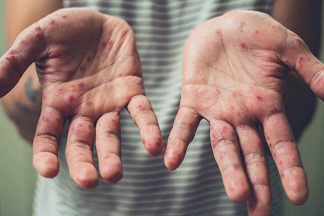 В 2019 году в мире от кори умерли более 200 тысяч человек