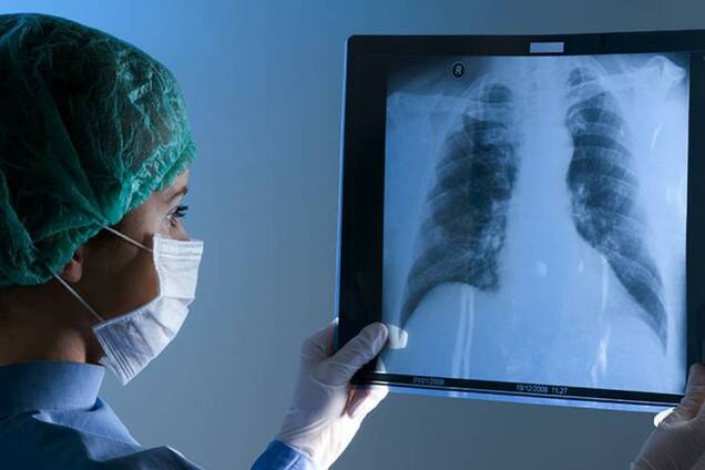 Лікарка розповіла, як відновити нормальну роботу легень після COVID-19