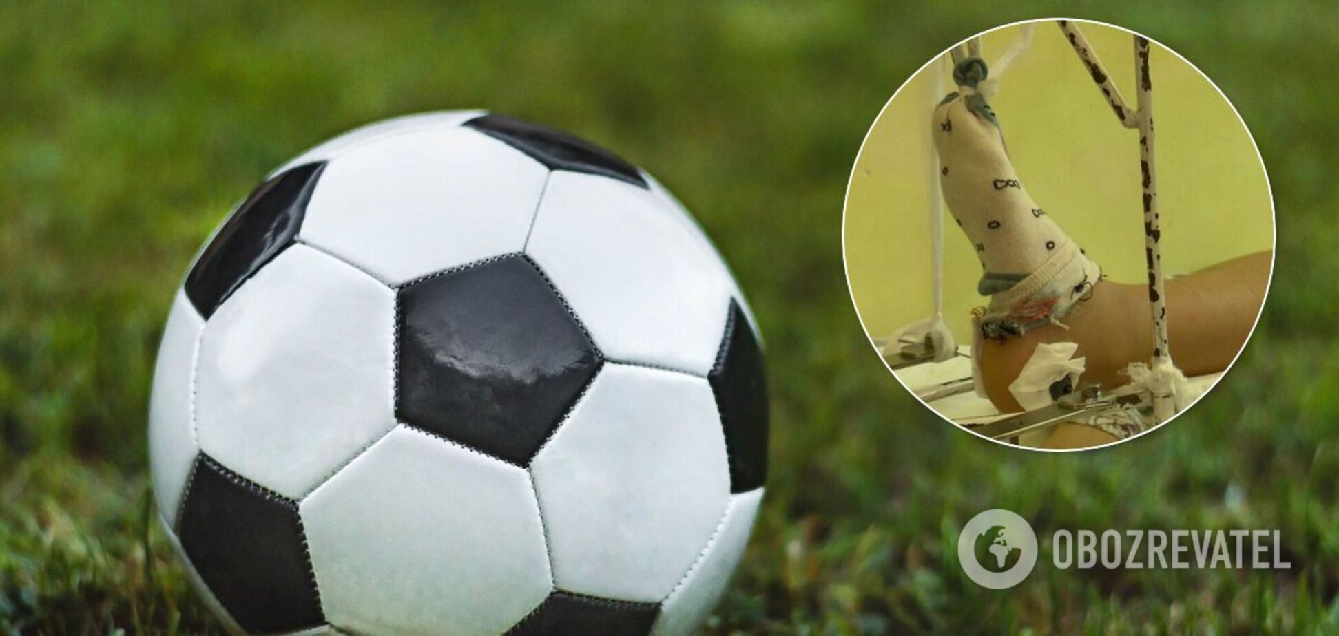 Ребенок сломал ногу во время игры в футбол