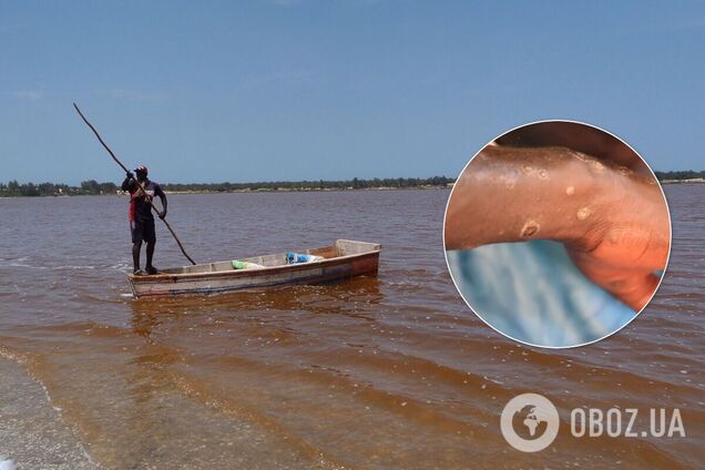 У больных наблюдаются высыпания на коже