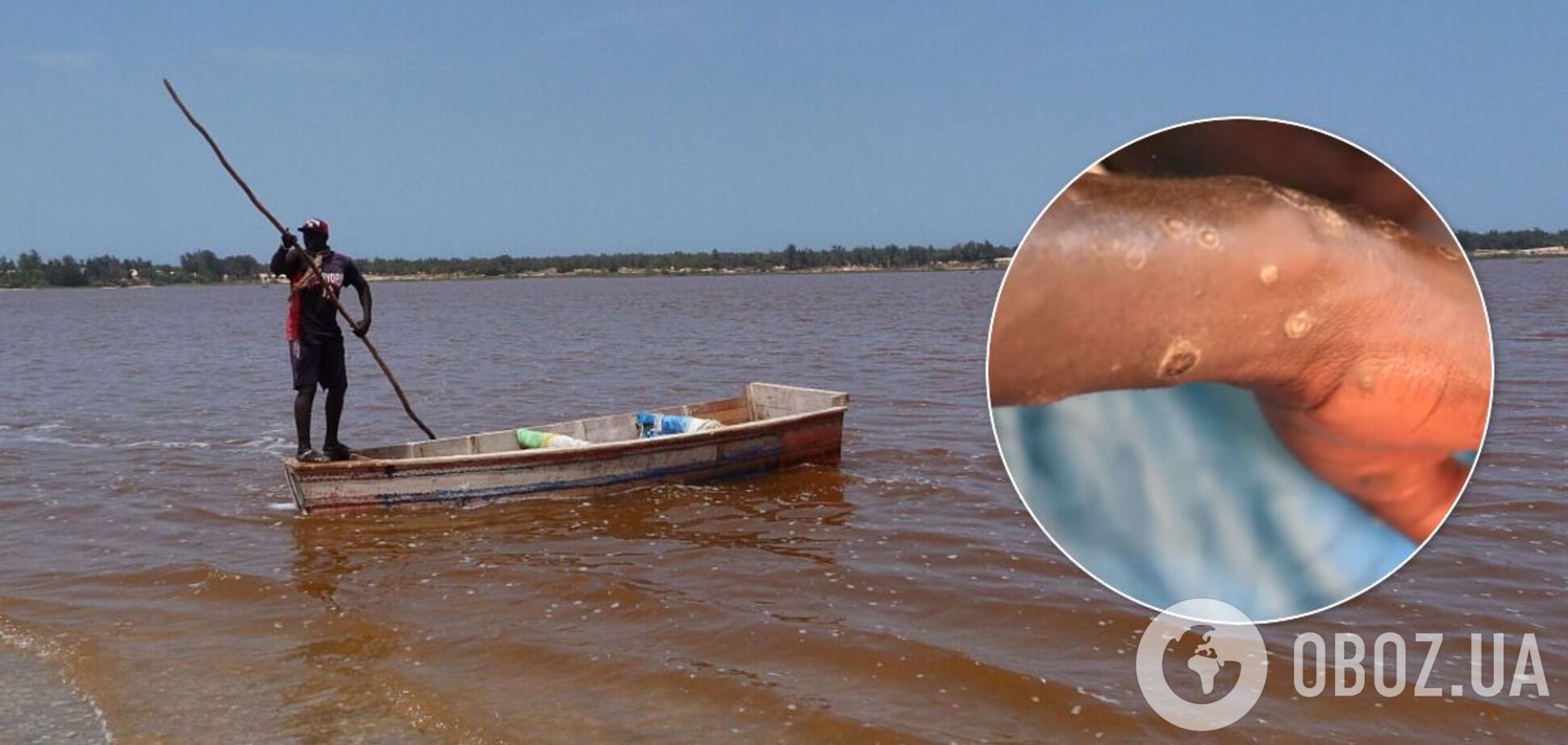 У больных наблюдаются высыпания на коже